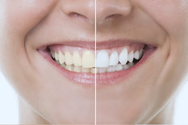 Before and after a whitening and cosmetic treatment
