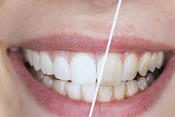 Before and after professional scaling and polishing