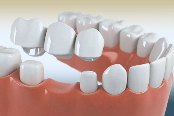 Dental Crowns & Bridges at Just Dent