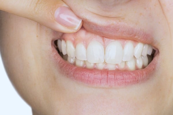 Periodontal Therapy at Just Dent